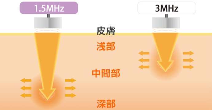 低出力パルス超音波 1